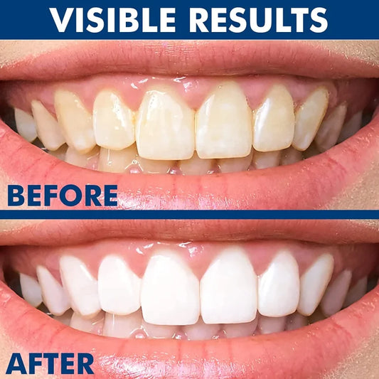 Dazzling White Instant Teeth Whitening Pen | Whiter Dental Lab Gel Cleaning Remove Stain Oral Hygiene