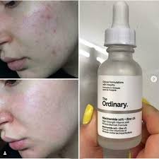 The Ordinary Niacinamide 10% + Zinc 1 % – 30ml |oil Control, Pore Minimizing & Blemish Solution Serum|